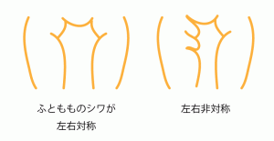 股関節脱臼-シワ